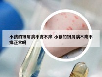 小孩的银屑病不疼不痒 小孩的银屑病不疼不痒正常吗