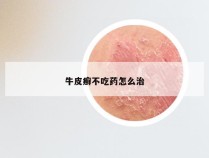 牛皮癣不吃药怎么治