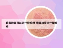 狼毒软膏可以治疗股癣吗 狼毒软膏治疗脚癣吗