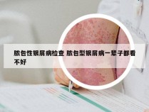 脓包性银屑病检查 脓包型银屑病一辈子都看不好