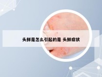 头鲜是怎么引起的是 头鲜症状