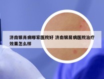 济南银肖病哪家医院好 济南银屑病医院治疗效果怎么样