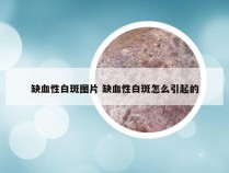 缺血性白斑图片 缺血性白斑怎么引起的