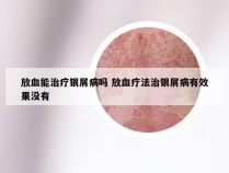 放血能治疗银屑病吗 放血疗法治银屑病有效果没有