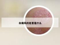 白癜风的危害是什么