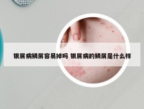 银屑病鳞屑容易掉吗 银屑病的鳞屑是什么样