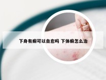 下身有癣可以自愈吗 下体癣怎么治