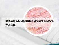 银消病打生物制剂那种好 银消病生物制剂治疗怎么样