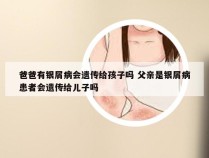 爸爸有银屑病会遗传给孩子吗 父亲是银屑病患者会遗传给儿子吗