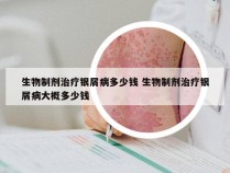 生物制剂治疗银屑病多少钱 生物制剂治疗银屑病大概多少钱