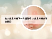 女人身上长癣下一代遗传吗 人身上长癣会不会传染