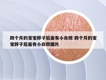 四个月的宝宝脖子后面有小白斑 四个月的宝宝脖子后面有小白斑图片