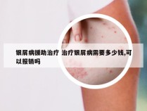 银屑病援助治疗 治疗银屑病需要多少钱,可以报销吗