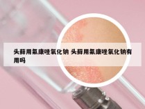 头藓用氟康唑氧化钠 头藓用氟康唑氧化钠有用吗