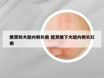 腋窝和大腿内侧长癣 腿窝腋下大腿内侧长红癣