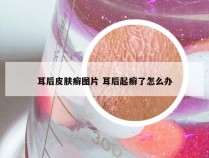 耳后皮肤癣图片 耳后起癣了怎么办