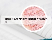 鳞癣是什么样子的图片 鳞屑癣图片及治疗方法