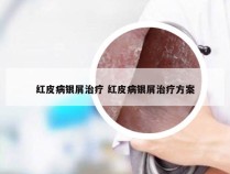 红皮病银屑治疗 红皮病银屑治疗方案