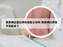 银屑病还是红疹阶段能止住吗 银屑病红疹变平后起皮了