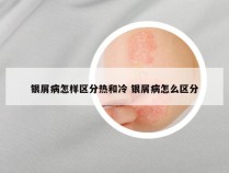 银屑病怎样区分热和冷 银屑病怎么区分