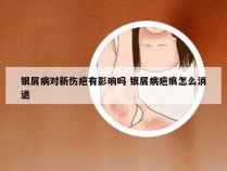 银屑病对新伤疤有影响吗 银屑病疤痕怎么消退