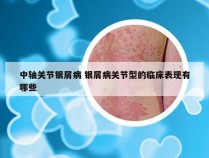 中轴关节银屑病 银屑病关节型的临床表现有哪些