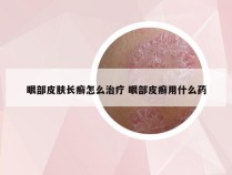 眼部皮肤长癣怎么治疗 眼部皮癣用什么药