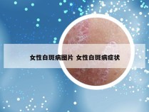 女性白斑病图片 女性白斑病症状