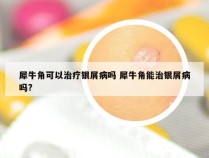 犀牛角可以治疗银屑病吗 犀牛角能治银屑病吗?