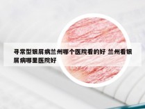 寻常型银屑病兰州哪个医院看的好 兰州看银屑病哪里医院好