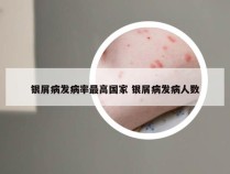 银屑病发病率最高国家 银屑病发病人数