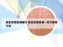 脓包性银屑病图片 脓包型银屑病一辈子都看不好