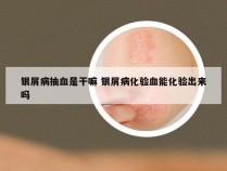 银屑病抽血是干嘛 银屑病化验血能化验出来吗