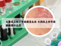 儿童头上长了牛皮癣怎么办 小孩头上长牛皮肤癣用什么药