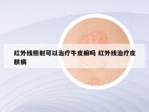 红外线照射可以治疗牛皮癣吗 红外线治疗皮肤病