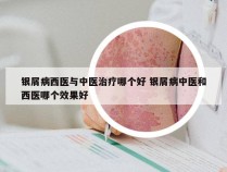 银屑病西医与中医治疗哪个好 银屑病中医和西医哪个效果好