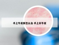 手上牛皮鲜怎么治 手上长牛皮