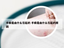 手癣是由什么引起的 手癣是由什么引起的原因