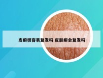 皮癣很容易复发吗 皮肤癣会复发吗