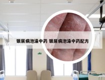 银屑病泡澡中药 银屑病泡澡中药配方