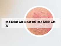 脸上长癣什么原因怎么治疗 脸上长癣怎么根治