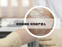 铜钱癣病因 铜钱癣严重么