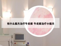 有什么偏方治疗牛皮廨 牛皮廨治疗小偏方