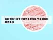 银屑病是不是牛皮廨会不会传染 牛皮廨银屑病传染吗