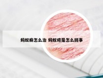 蚂蚁癣怎么治 蚂蚁疮是怎么回事