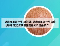 延边哪里治疗牛皮癣较好延边哪里治疗牛皮癣比较好 延边皮肤病医院是公立还是私立