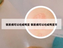 银屑病可以吃咸鸭蛋 银屑病可以吃咸鸭蛋不