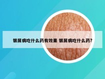 银屑病吃什么药有效果 银屑病吃什么药?