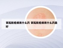 掌跖脓疱病用什么药 掌跖脓疱病用什么药最好