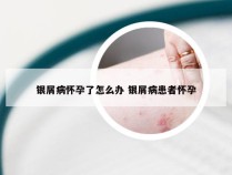 银屑病怀孕了怎么办 银屑病患者怀孕